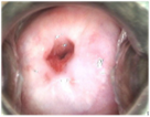 Prior Letz treatment