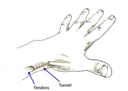 Dequervains syndrome
