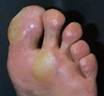 Callous